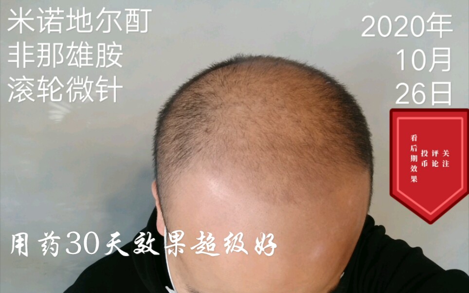 米诺地尔非那雄胺微针用药30天效果图集自己做实验生发记录片特别版