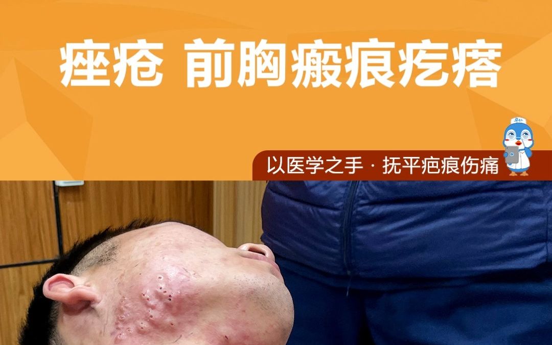 下巴疤痕疙瘩痤疮痘痘疤痕疙瘩大面积疤痕保定华仁疤痕修复-保定祛疤