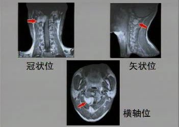 椎管内肿瘤的诊断和治疗哔哩哔哩bilibili