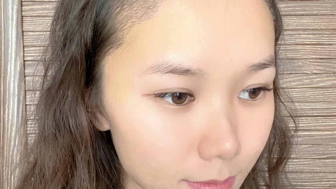 【植发案例分享】天生高额头,额角缺失小姐姐发际线恢复情况.