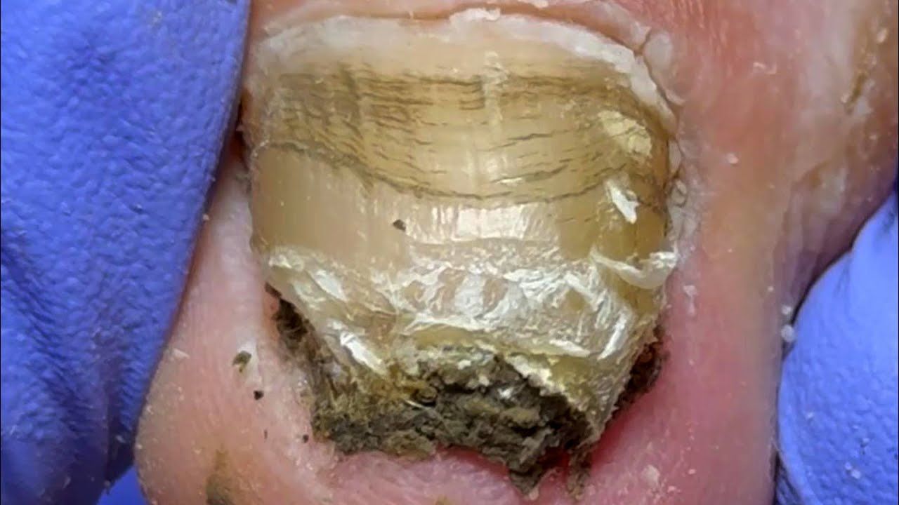 厚厚的灰指甲,细菌丛生,黑泥警告