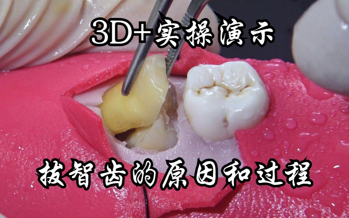 3D+实操演示:拔智齿的原因和过程哔哩哔哩bilibili