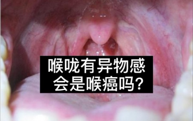 喉咙里有异物感会是喉癌吗去医院检查后,这病的名称第1次听说哔哩哔哩bilibili