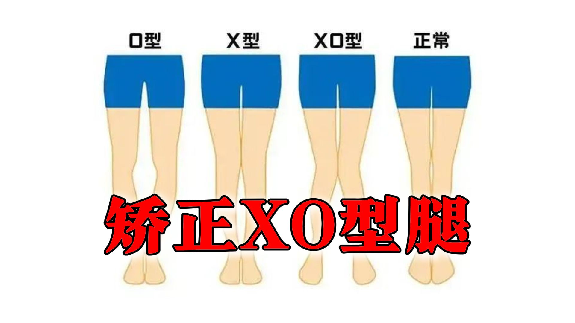 xo型腿如何矫正