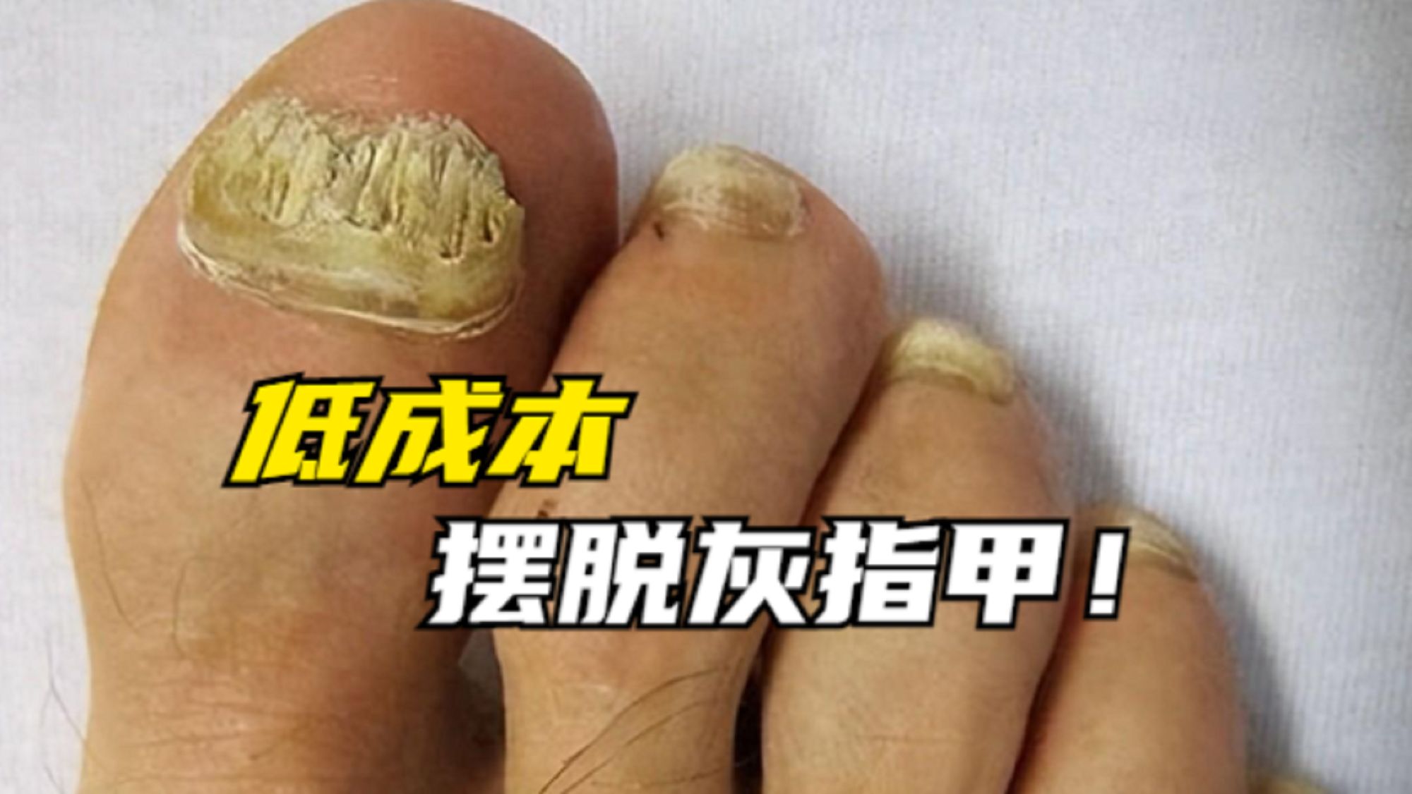 得了灰指甲真的很难治好吗?别再上当了!