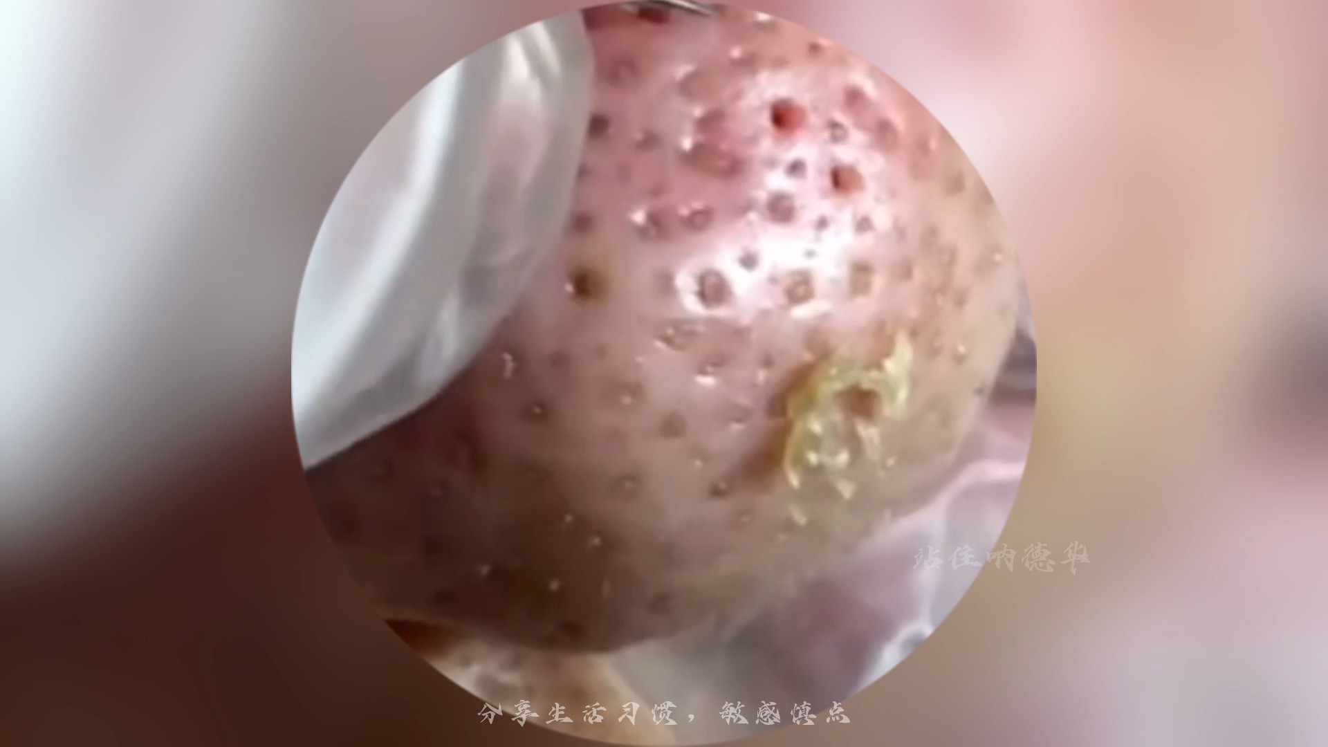 【密集恐惧,慎点别点】如同火山爆发熔浆喷射般,你见过这么粗大的毛孔