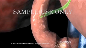 3d医学动画 腹腔镜胆囊切除 中英双字幕 原版英文 哔哩哔哩 つロ干杯 Bilibili