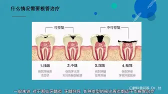 Download Video: 根管治疗的基本流程有哪些