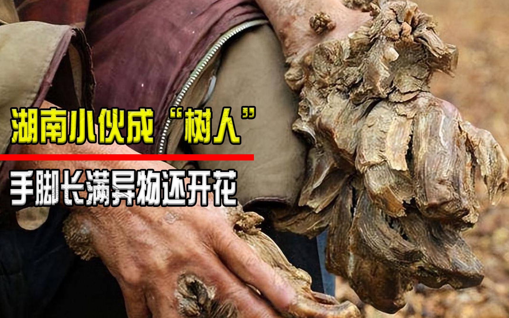 湖南小伙成"植物人",手脚长出树皮还开花,专家道出真相