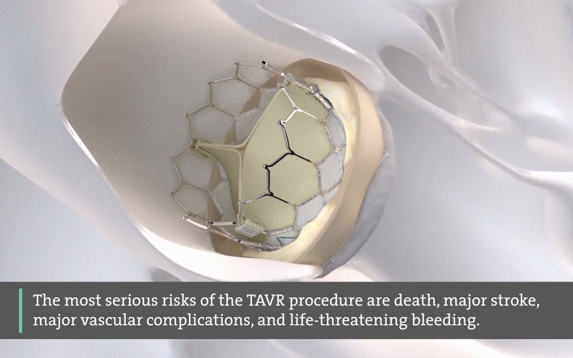 Transcatheter Aortic Valve Replacement (TAVR)  See the Procedure哔哩哔哩bilibili