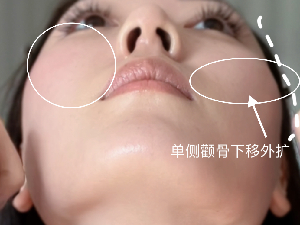 你是不是也颧骨不对称!大小脸!