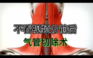 下载视频: 3D动画|气管切除术|颈部解剖学习