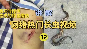 Download Video: 网络热门长虫视频(72)女子散步时被4斤五步蛇咬中额头？摔倒后又被蜱虫叮咬？险些丧命！