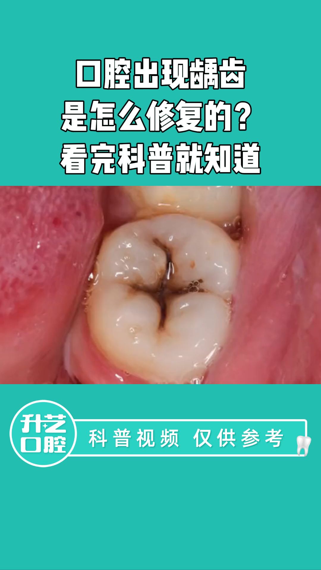 口腔出现龋齿是怎么修复的?看完科普就知道哔哩哔哩bilibili