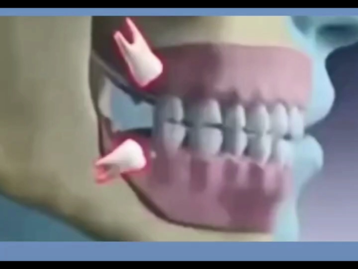 3d动画演示 智齿拔除过程