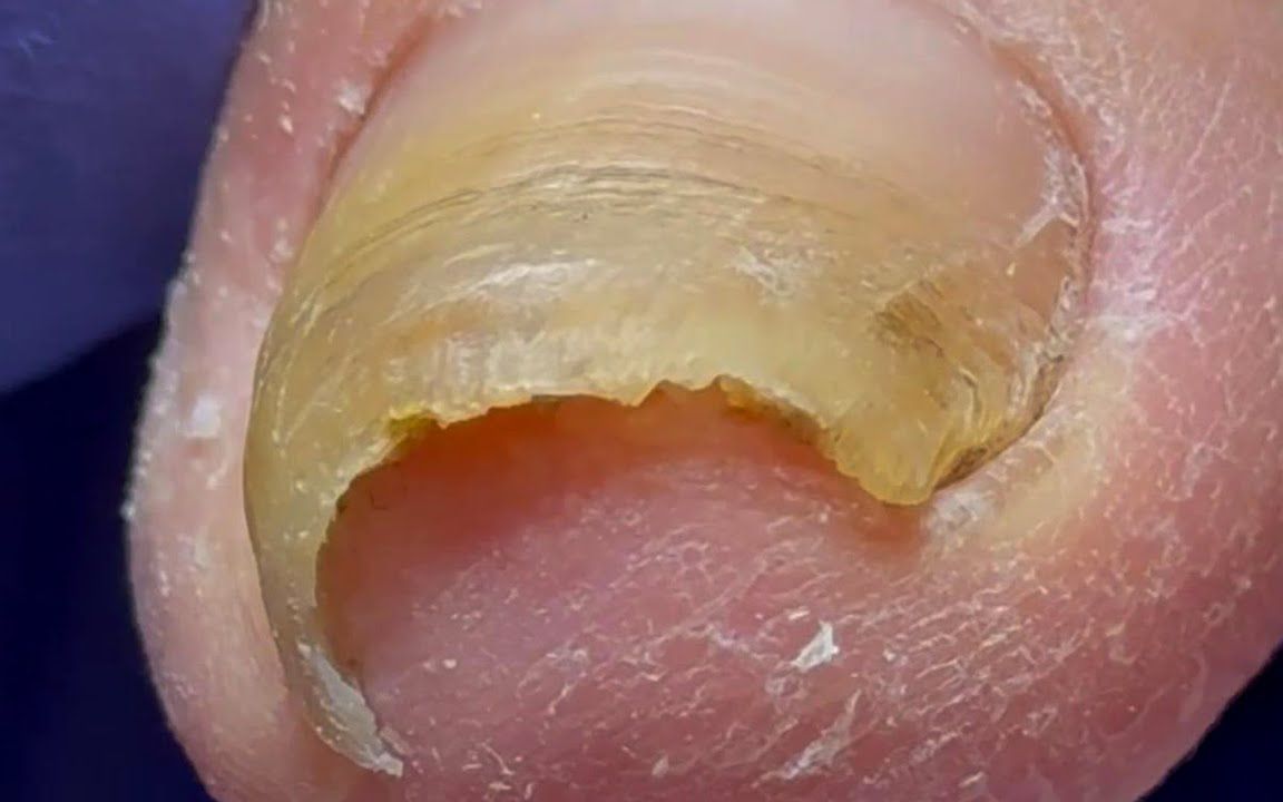 【内嵌甲】指甲疯狂生长,卷曲,嵌入指甲