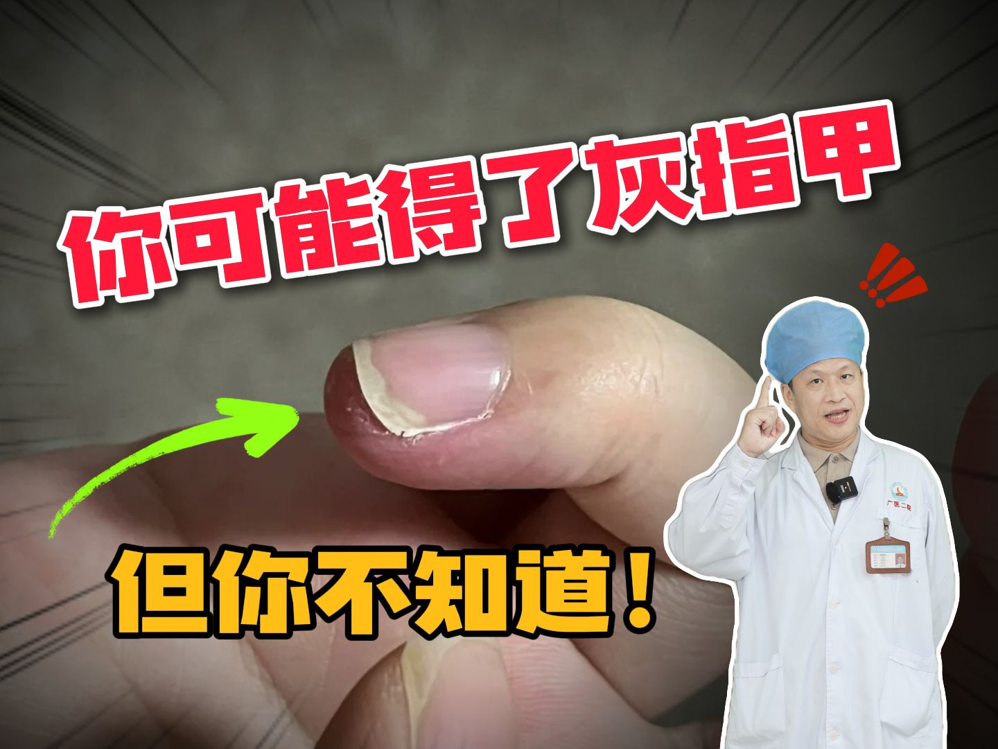 【科普】指甲有白点、空甲都有可能是灰指甲的早期症状,建议发现要及时处理!哔哩哔哩bilibili