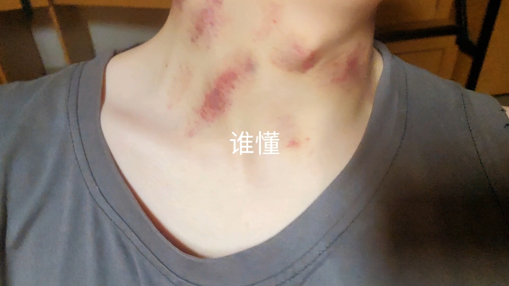 男大学生发问:如何消掉被脖子上的草莓