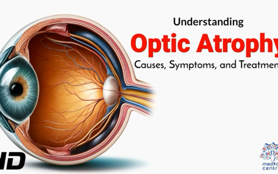 Optic Atrophy Explained: Causes, Symptoms, and Treatment Options视神经萎缩说明原因特征治疗方法哔哩哔哩bilibili