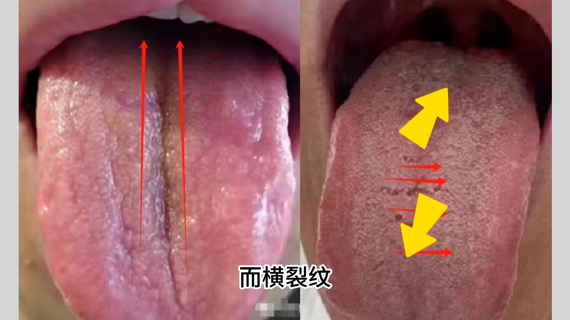 舌诊分析:舌头上,竖裂纹代表痛,横裂纹代表胀哔哩哔哩bilibili