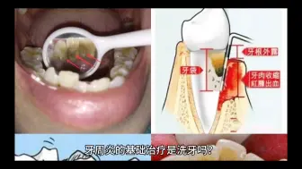 下载视频: 牙周炎的基础治疗是洗牙吗？