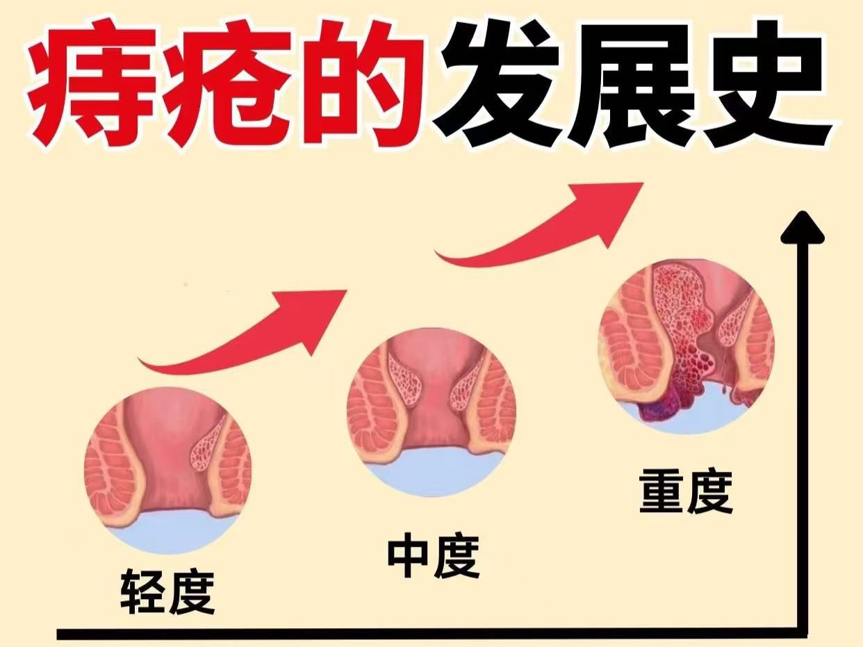 自查你的痔疮在第几级?该如何解决?