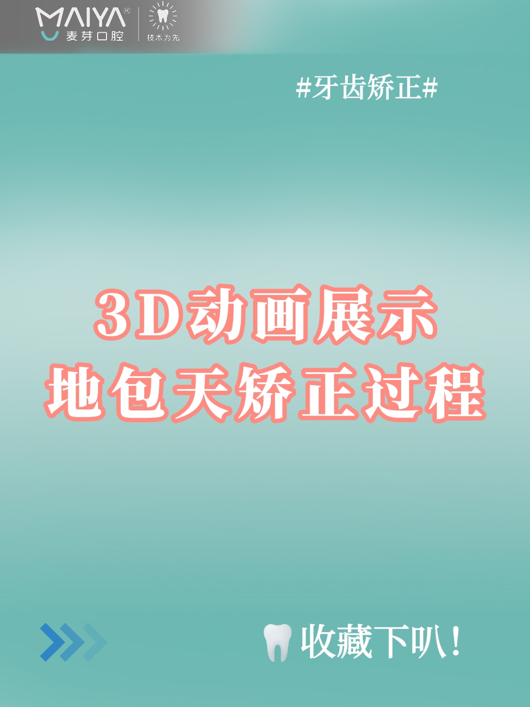 3D动画展示:地包天矫正过程(麦芽口腔)哔哩哔哩bilibili