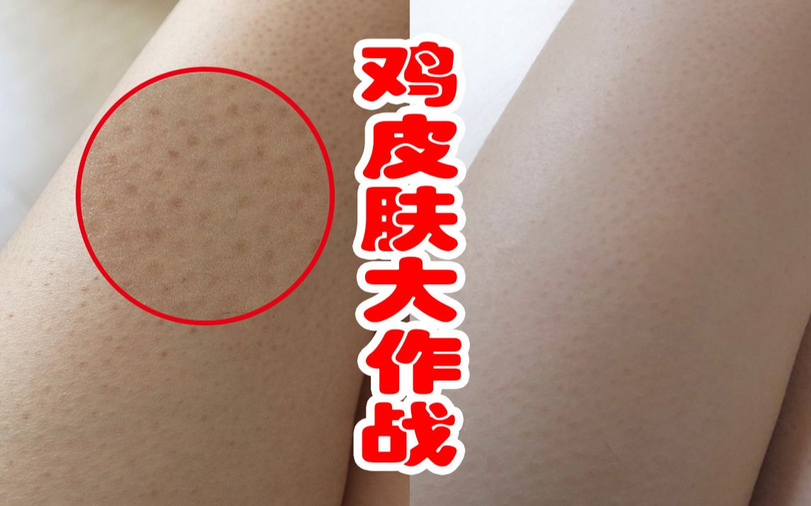 光滑的鸡皮肤怎么去(怎么去除鸡皮肤,让皮肤光滑)