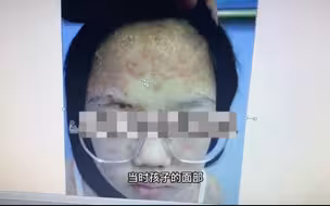 住校生一床被子三年不换，全身瘙痒满脸红斑，牛皮癣蹬鼻子上脸！