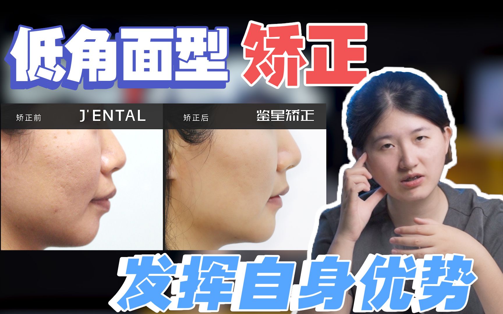 活动作品低角面型也能有翘下巴发挥先天优势一副牙套让你改头换面