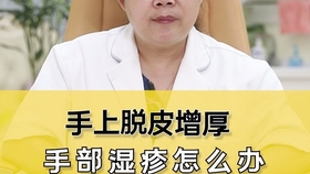 No4 手上密集很痒的小水泡 到底是不是汗疱疹 怎么办 哔哩哔哩 つロ干杯 Bilibili