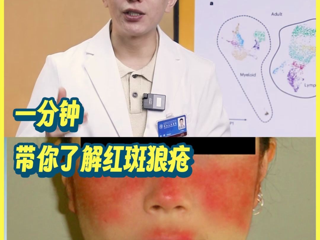 一分钟带你了解红斑狼疮