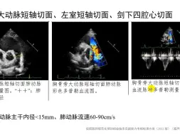 Download Video: 大动脉短轴切面、左室短轴切面、剑下四腔心切面