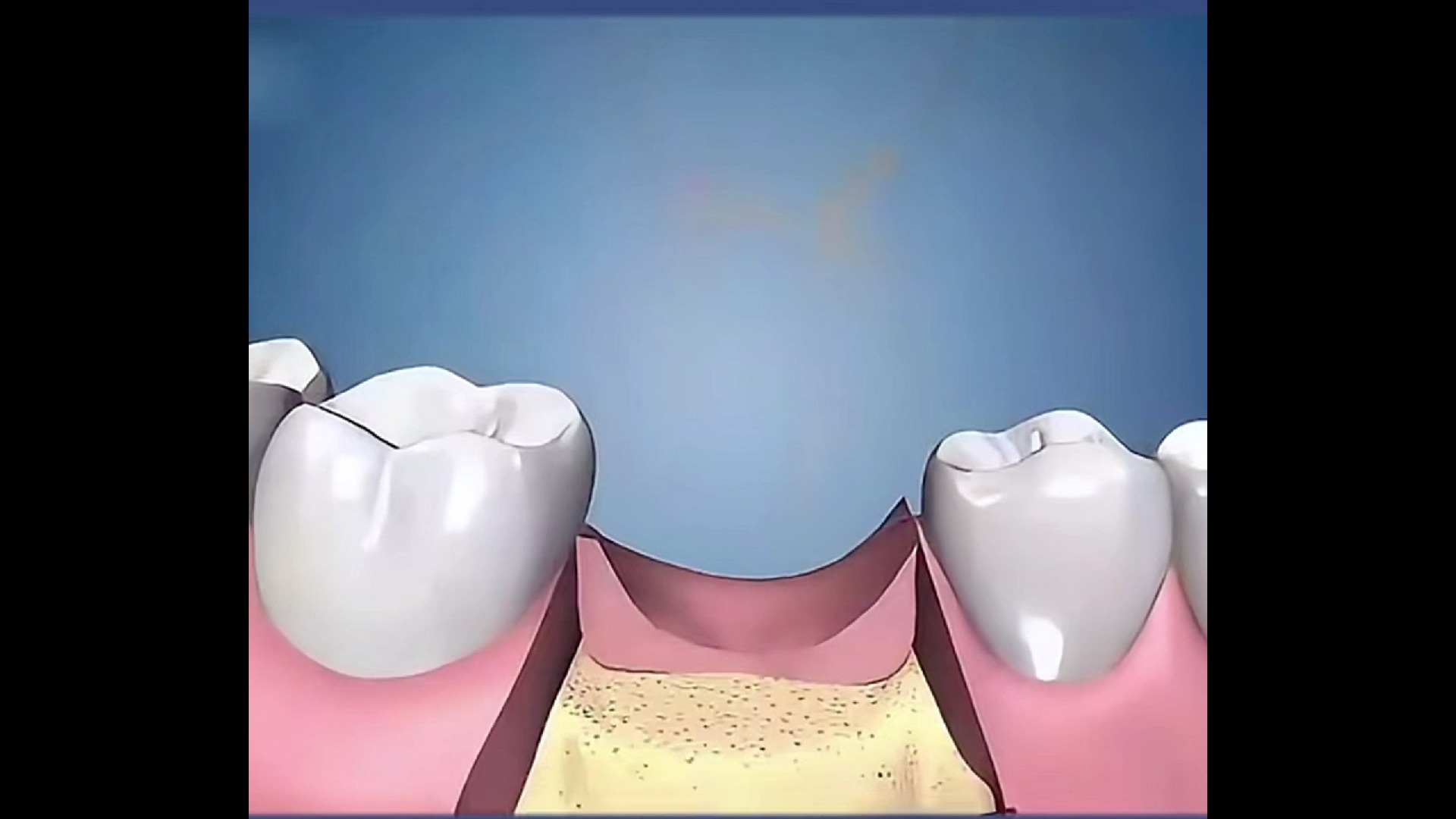 清楚认识种植牙全过程