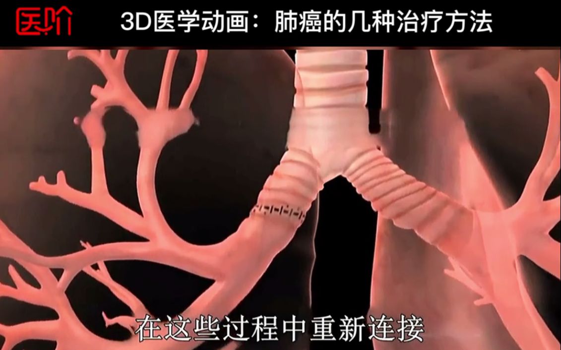 3D医学动画:肺癌的几种治疗方法哔哩哔哩bilibili