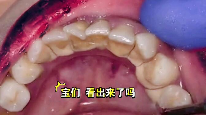 偏侧咀嚼的小姐姐,右侧堆满牙结石!