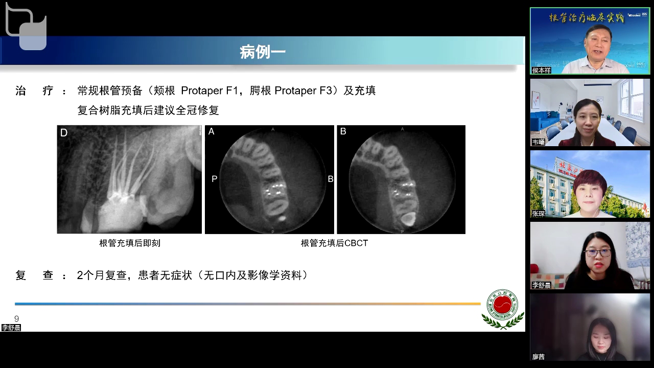 [图]开髓术