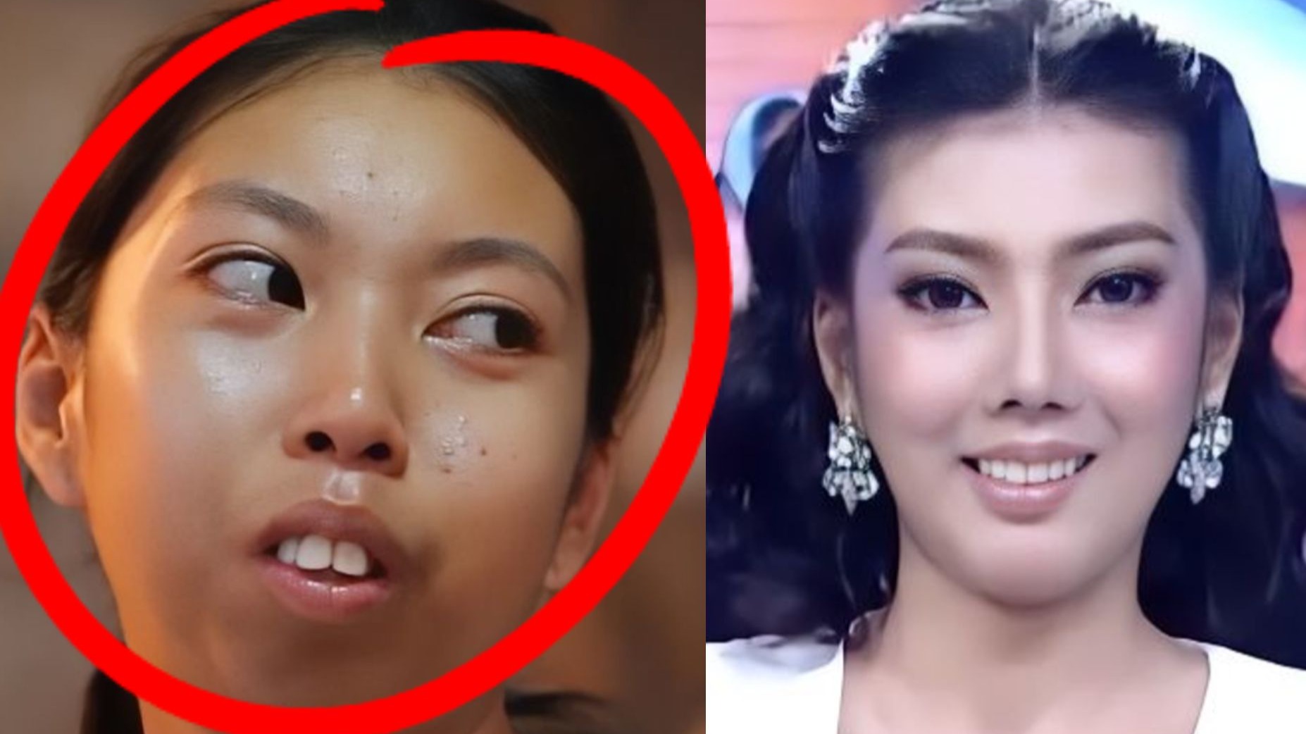 这才是整容存在的意义 泰国美女天生没有下巴,整容后迎来全新人生