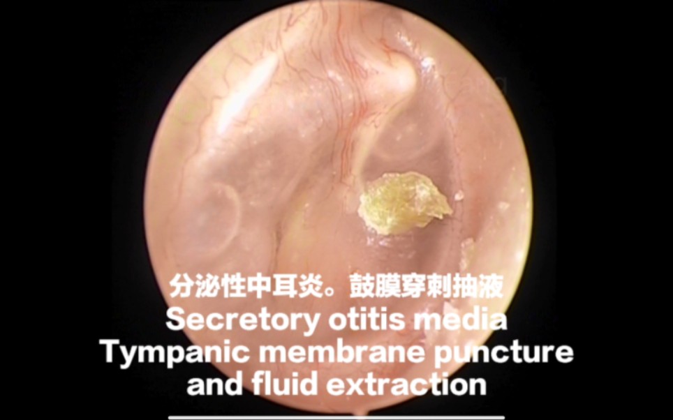 分泌性中耳炎鼓膜穿刺抽液Tympanic membrane aspiration+Myringotomy20230927.06哔哩哔哩bilibili