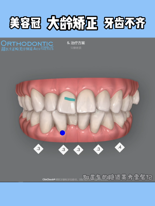 北大正畸博士的隐适美方案笔记丨54岁隐适美矫正牙齿不齐,拆除美容冠,解决锁合,改善面部美学哔哩哔哩bilibili