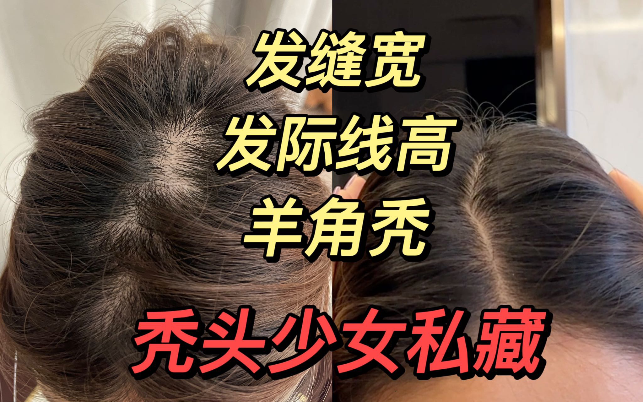 【真实生发经验】正确使用米诺地尔!生发!真的好?! - 哔哩哔哩