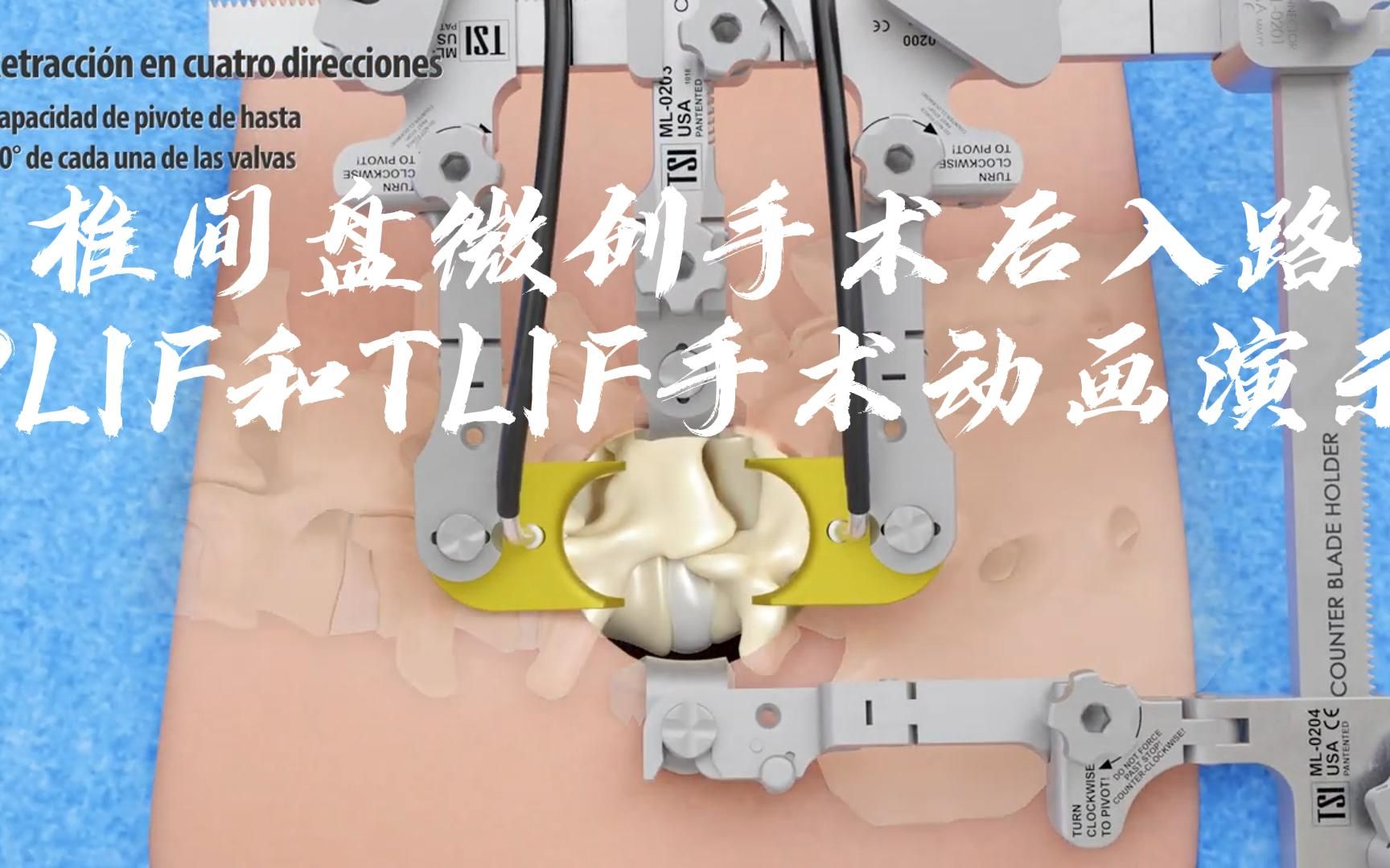 椎间盘后入路pliftlif微创手术演示