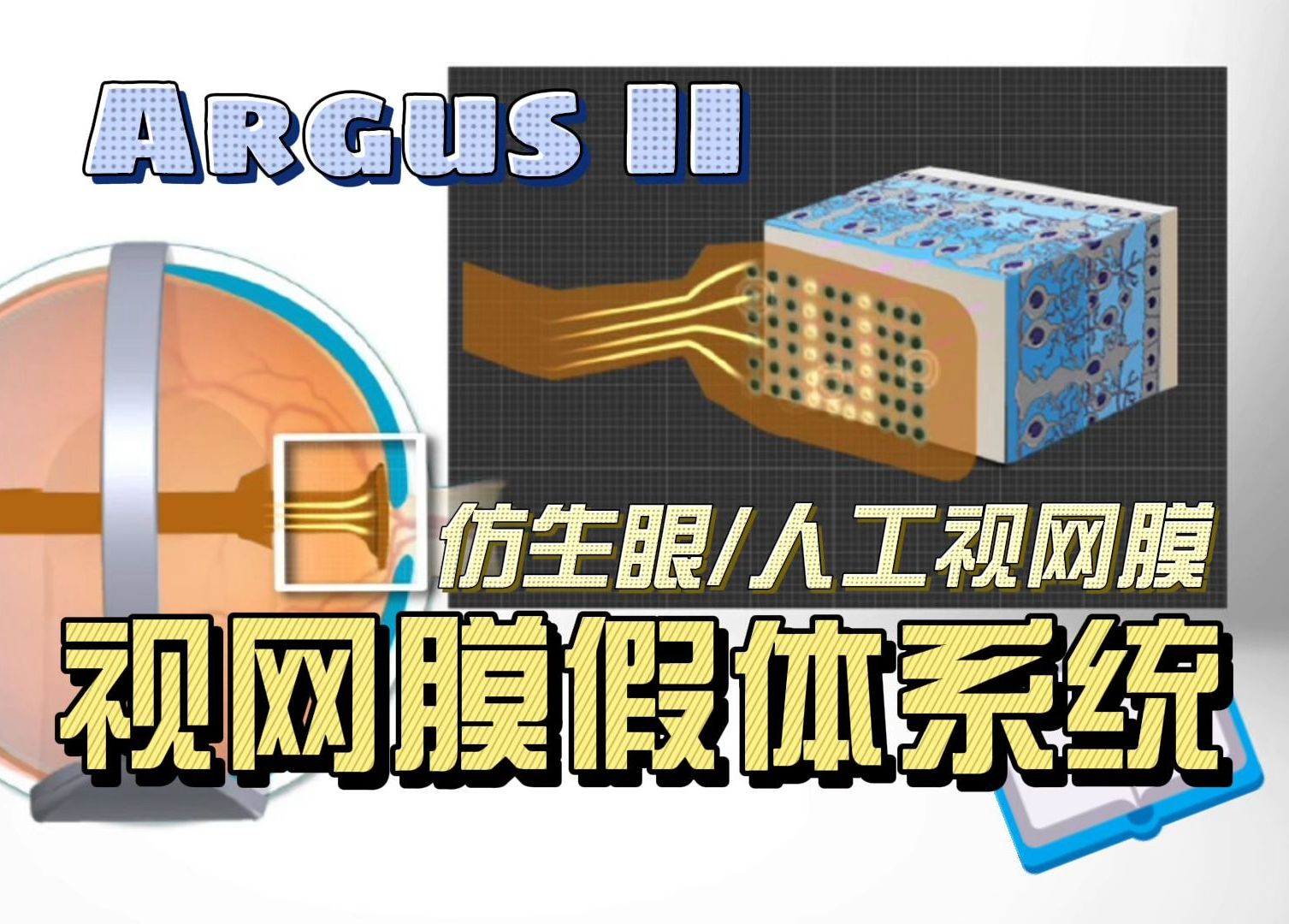 argus ii 人工视网膜