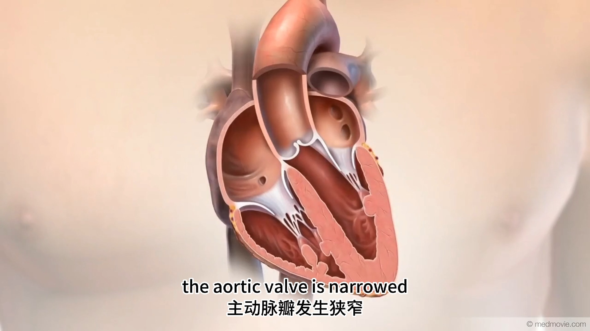 什么是主动脉瓣狭窄？