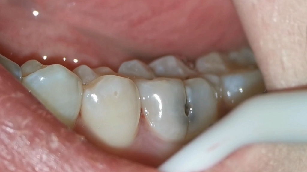 大牙牙齿侧面的黑点里面到底有多大?