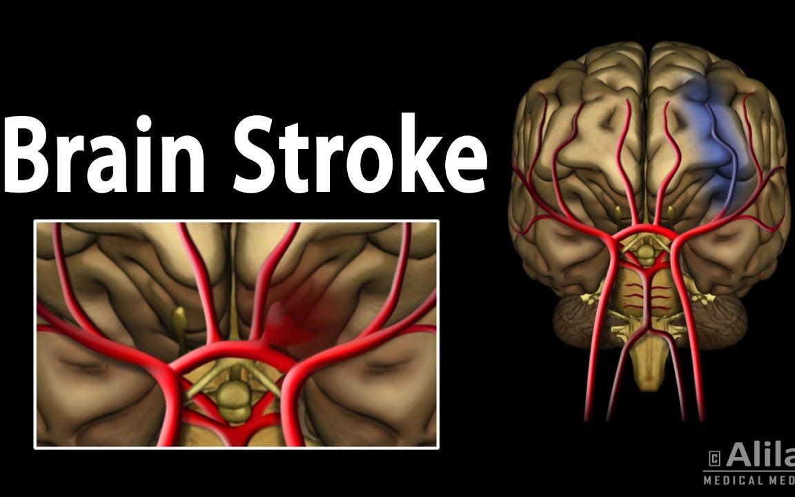 动画 | 脑卒中(中风)的类型/病理/症状/治疗哔哩哔哩bilibili