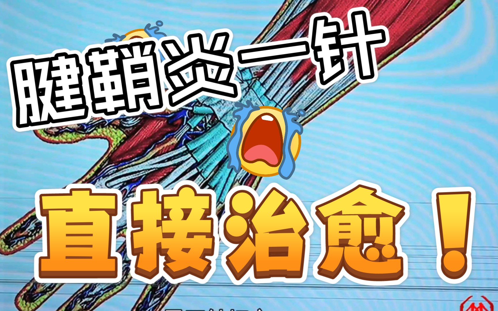 【中医针灸】狭窄性腱鞘炎一针当场见效!_哔哩哔哩_bilibili