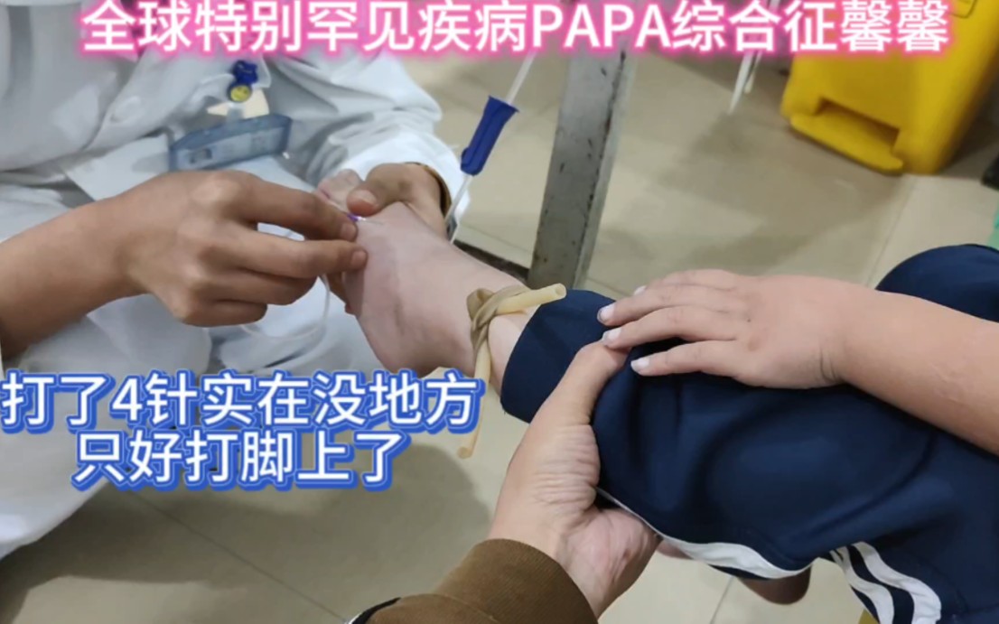 馨馨患papa综合征7年多了,今天打了4针实在没地方打了只能打脚上了