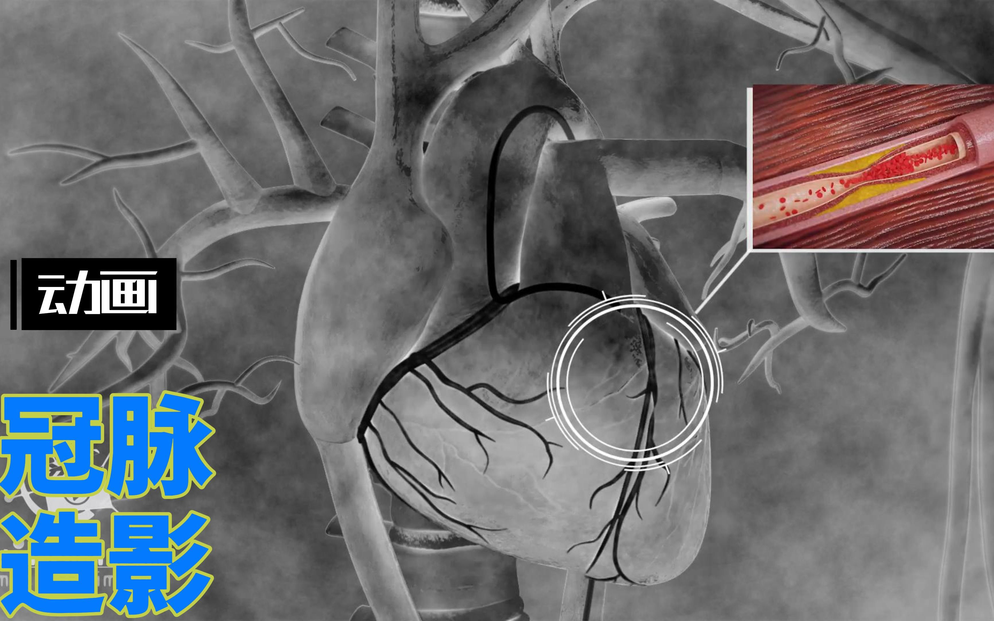 冠状动脉造影动画演示图片