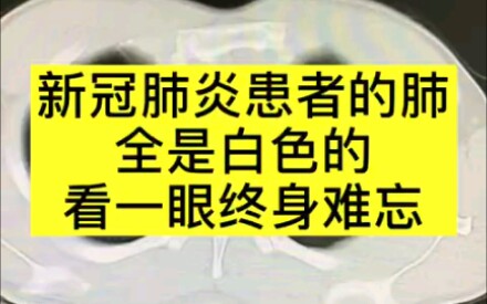 [图]为什么新冠患者呼吸困难？看看他们的肺就知道了